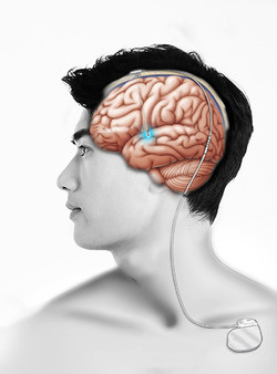 뇌심부자극술로 자극용 전극을 신체에 삽입한 모식도(사진 제공: 서울대병원). 