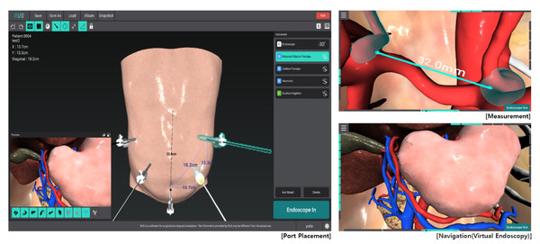 ​휴톰의 내시경영상치료계획 소프트웨어 RUS의 실제 작동 화면. 딥러닝 기술을 이용해 수술에 필요한 해부학적 구조를 완벽하게 구현한다. 