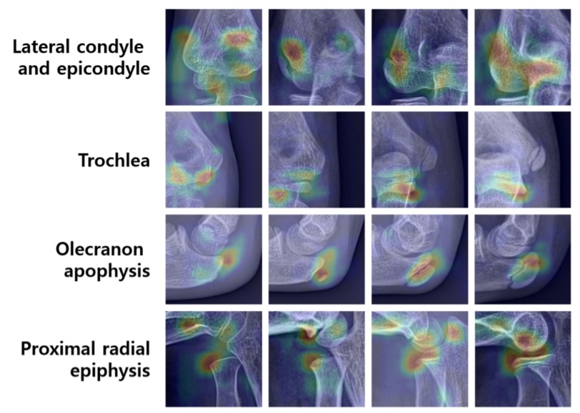 그림. 다양한 뼈 연령대의 팔꿈치 방사선 사진의 히트 맵