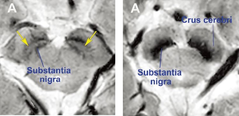 정상 모양의 흑질(왼쪽)과 파킨슨병 환자의 흑질(오른쪽) MRI 영상. 왼쪽 정상인의 MRI 영상에 노란색 화살표가 가리키는 밝은 부분이 존재하는 것과 달리 파킨슨병 환자는 도파민 신경세포 소실로 해당 부분이 새까맣게 나타난다(사진 제공: 분당서울대병원).