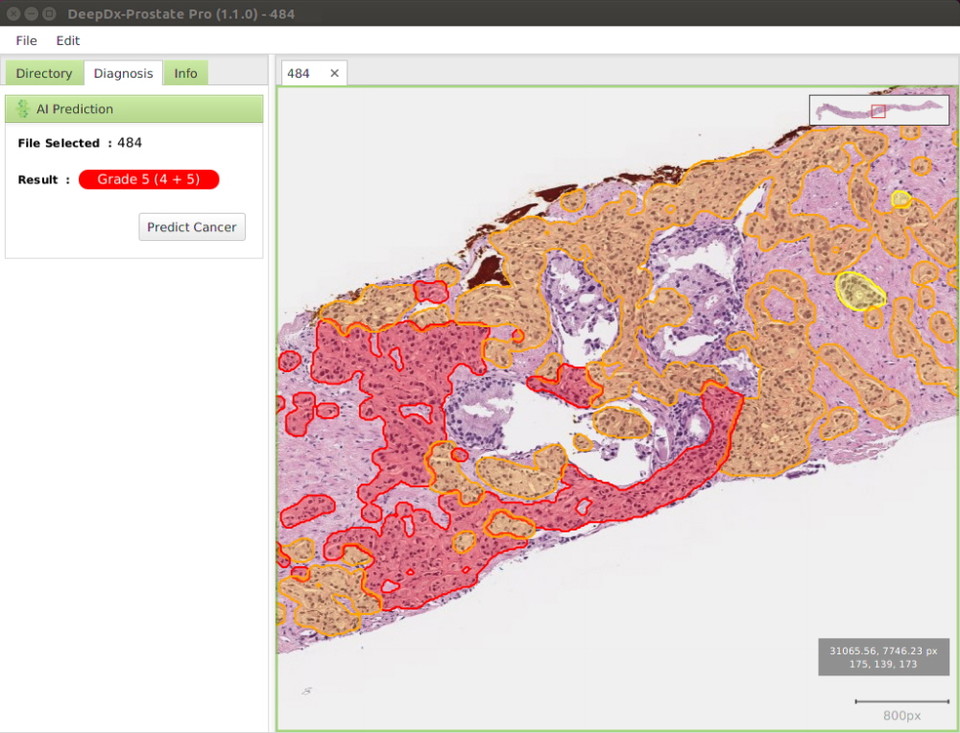 딥바이오 'DeepDx-Prostate Pro' 슬라이드 분석 화면.