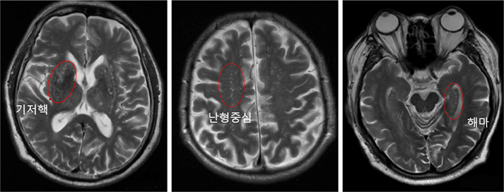 (왼쪽부터) 기저핵, 난형중심, 해마 부위 뇌혈관 주위 공간 확장이 심한 환자의 뇌 MRI 영상(사진제공: 인제대 상계백병원)