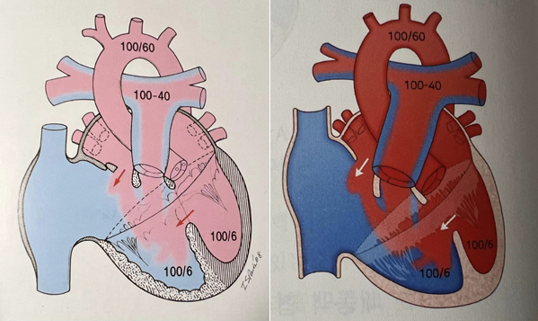 왼쪽 그림은 박인숙 전 의원이 쓴 '선천성 심장병'에 담긴 모식도. 오른쪽은 '한방소아청소년의학'에 있는 심장 모식도(사진제공: 박인숙 전 의원).