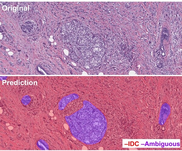 유방암 AI분석 알고리즘 모델 이미지(사진제공: 딥바이오)