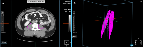 CT데이터에서 AI로 추정된 요근 형태 (사진제공: 코어라인소프트)