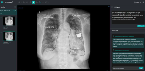 흉부 X-ray 판독에서 M4CXR(연구용)의 사용 예시 (사진 제공: 딥노이드)