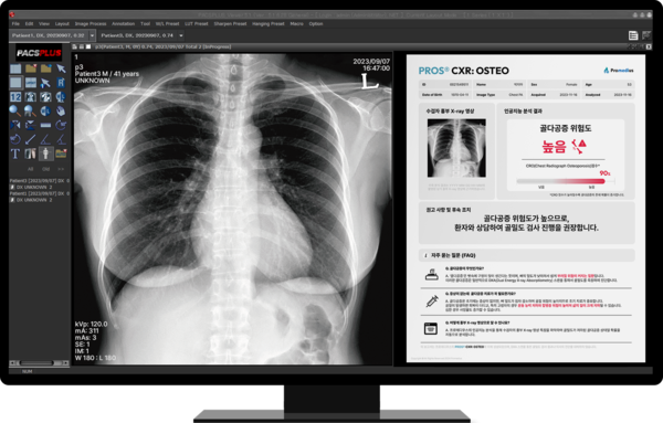 골다공증 진단 보조 AI 소프트웨어 ‘프로스 CXR: 오스테오’ 이미지.