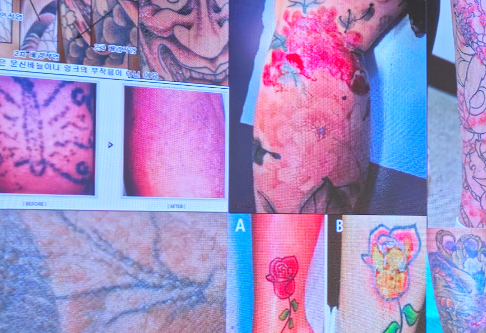 문신사법'이 국회 상임위원회를 통과하면서 의료계 우려도 고조되고 있다. 사진은 대한의사협회가 공개한 문신 시술 부작용 사례(ⓒ청년의사).