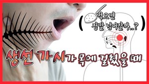 생선 가시가 목에 걸렸을 때, 어떻게 해야 할까?!-[나는의사다 900회] < 나는 의사다 < 동영상 < 기사본문 - 청년의사