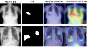 흉부 엑스레이 판독 능력 스스로 향상시키는 AI 기술 나왔다 < 의료 < 뉴스 < 기사본문 - 청년의사